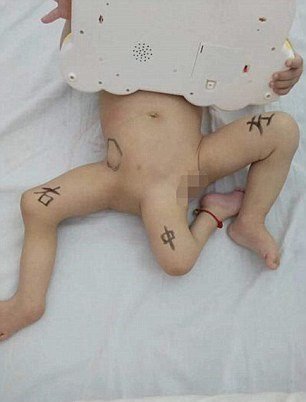 В Китае врачи провели операцию по удалению у ребенка третьей ноги