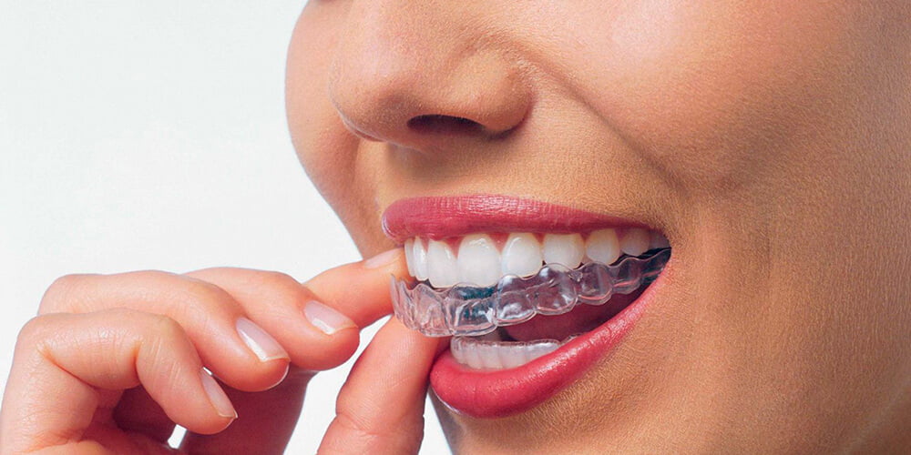 Капа для вирівнювання зубів - єфективність та безпечність